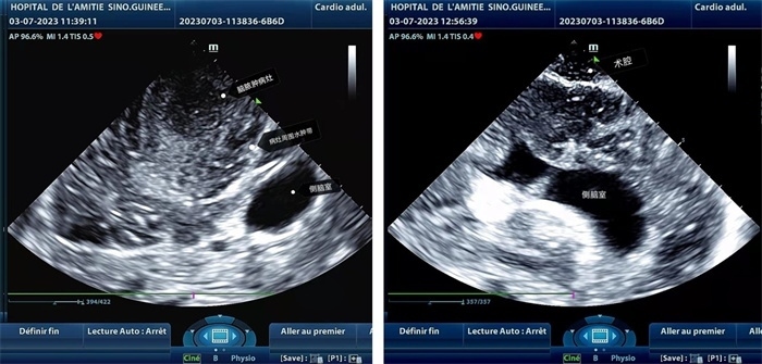左圖顯示術(shù)中超聲見(jiàn)囊實(shí)性病變，大小約為4x4x3cm，病灶周?chē)X組織水腫明顯；右圖為病灶切除后，術(shù)中超聲示術(shù)腔無(wú)病變殘留