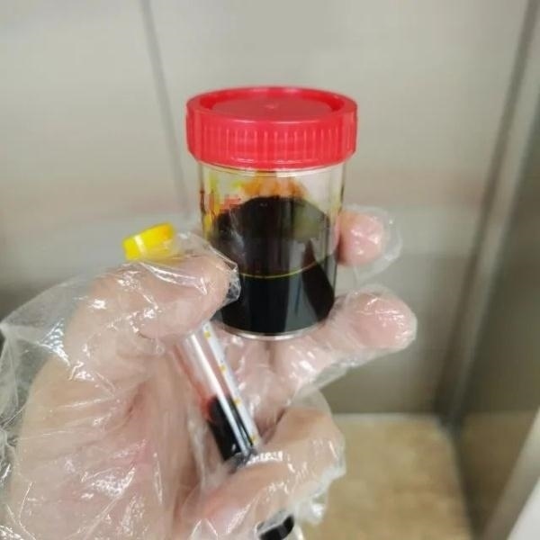 急性肝衰竭！兩兄弟誤吃這種菌 專家提醒