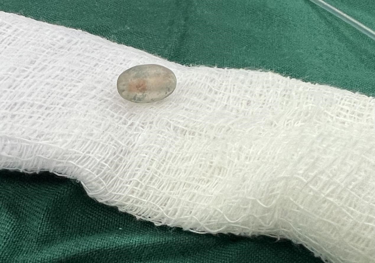 被取出的異物。中國援桑醫(yī)療隊(duì)供圖