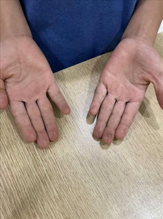 9歲小學(xué)生長期拍煙卡，手部粗糙長繭。受訪者供圖